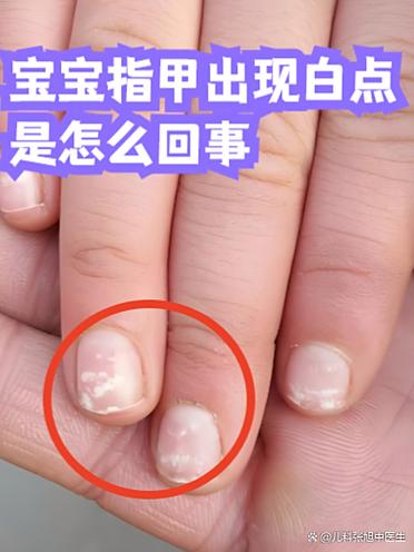 指甲上有气泡状的白点