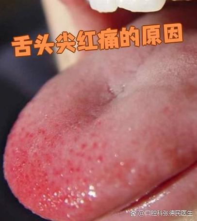 为什么舌头会有刺痛感