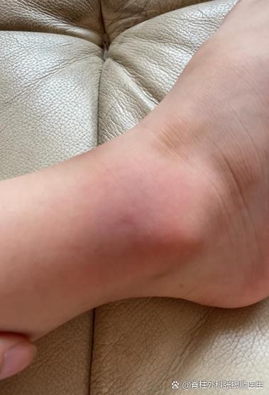 女生上体育课把脚丫子崴了那疼脱鞋