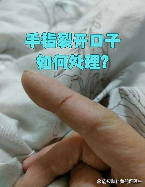洗碗多了手裂开口子怎么办