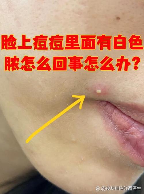 痘里面有白脓能挤吗