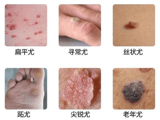 小肉疣怎么去除
