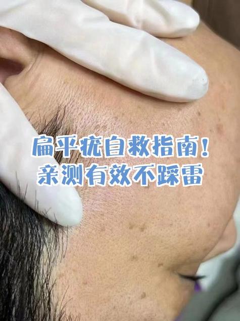 疣怎么治疗缩略图