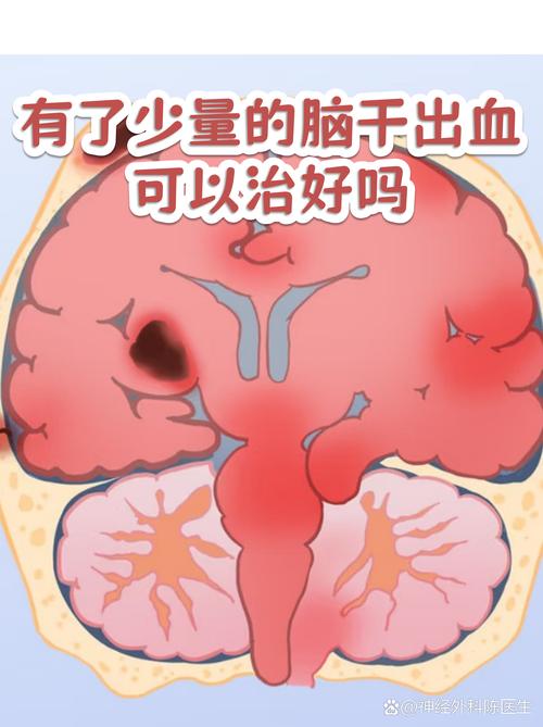 脑浆摔碎还能复原吗