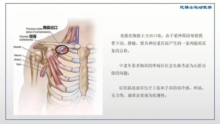 胸廓出口综合征是什么病缩略图