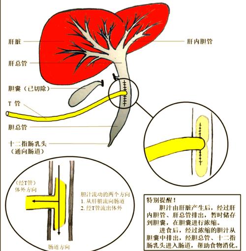 放置T管的适应征是