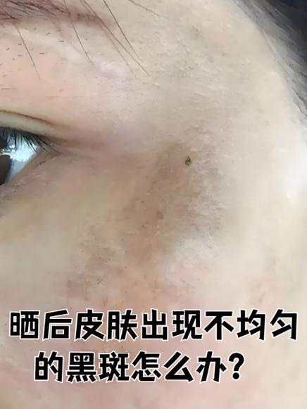 肤色不均匀暗沉怎么改善图标