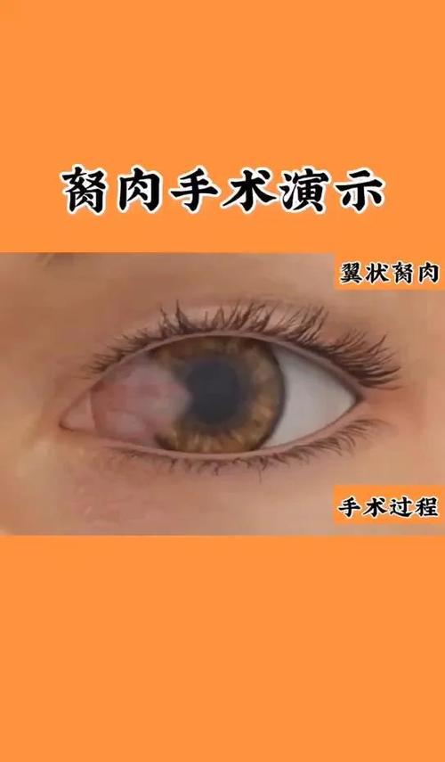 胬肉是什么意思游戏截图