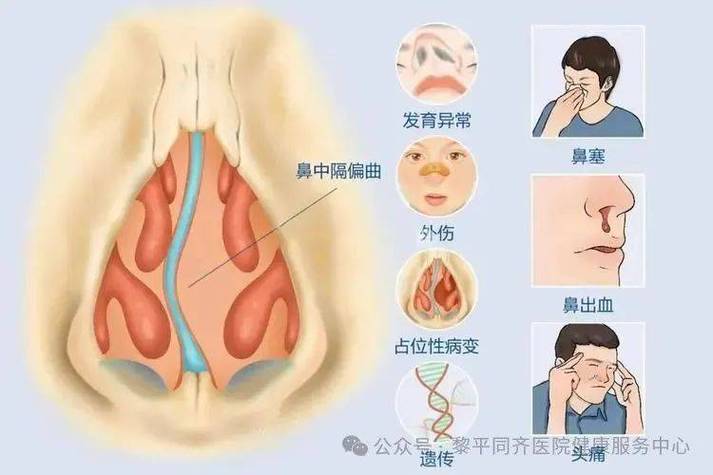 鼻中隔不规则偏曲严重吗