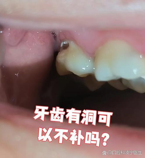 牙洞不补会不会越烂越大