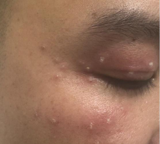 女生感染hpv初期症状