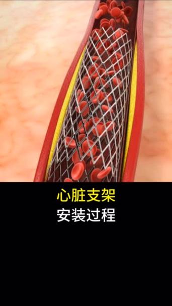 后悔装了支架