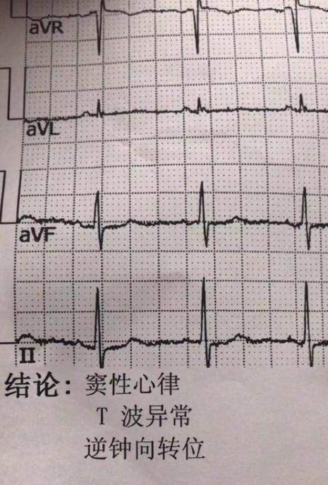 逆钟向转位是什么原因造成的