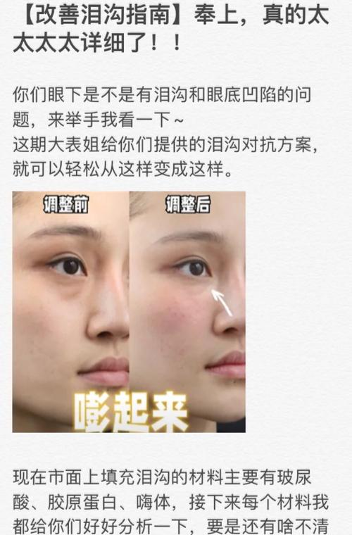 泪沟凹陷怎么解决最好