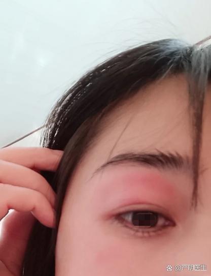女性眼睛红肿痒要警惕