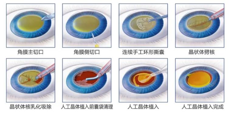 白内障手术风险有多大
