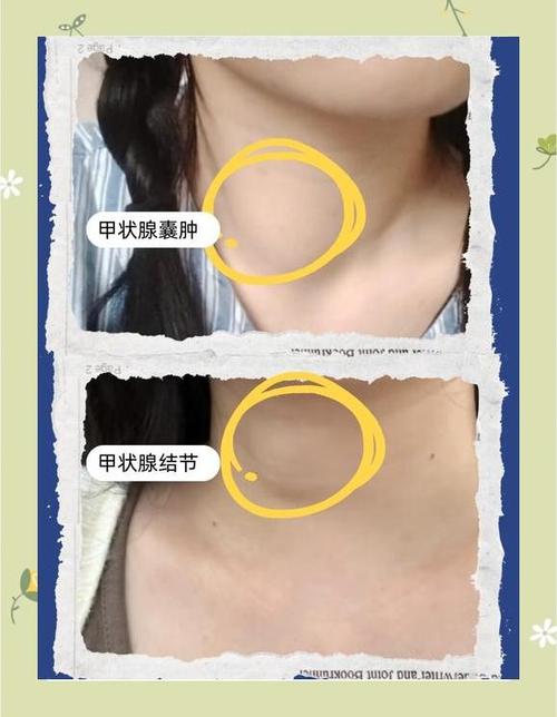 甲状腺