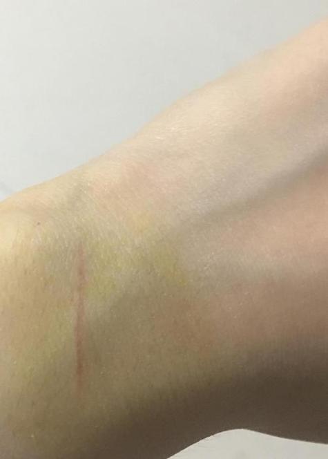猫抓的疤痕怎么去除