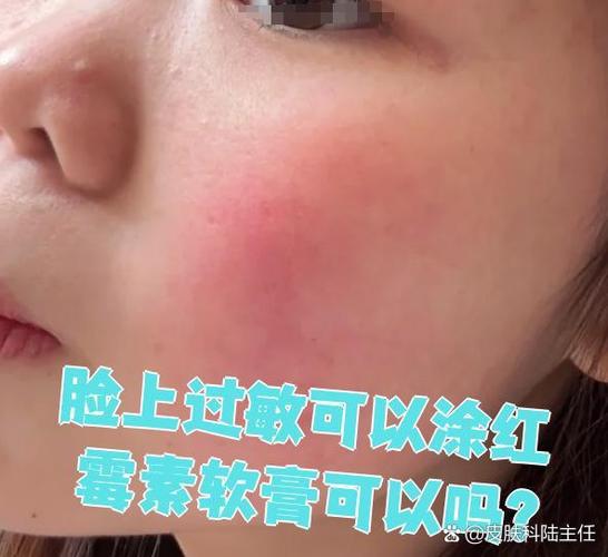 过敏了用红霉素软膏有用吗