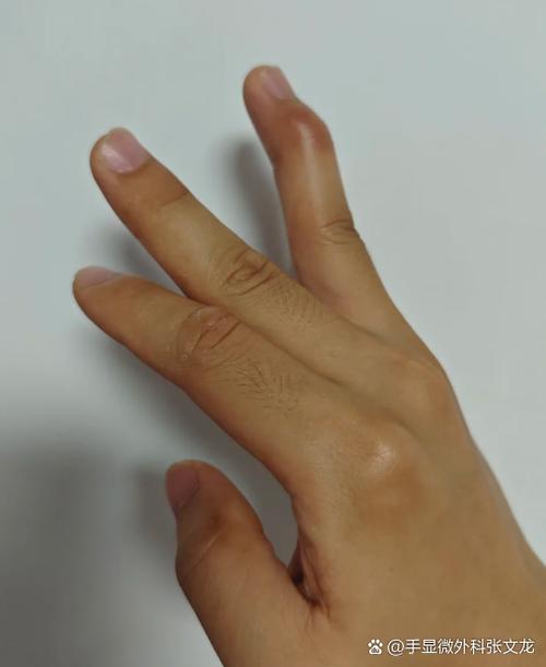 手指肉被压碎能愈合吗