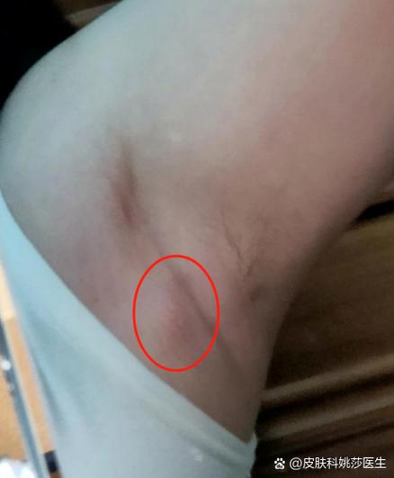 女性腋窝下往整个胳膊酸胀