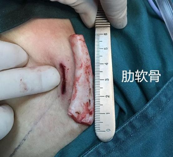 肋骨隆鼻会和鼻骨长在一起吗图标