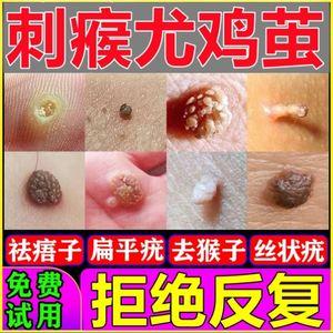 可尤可茧能治疗扁平疣吗缩略图