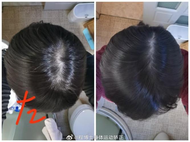 成人偏头可以矫正吗