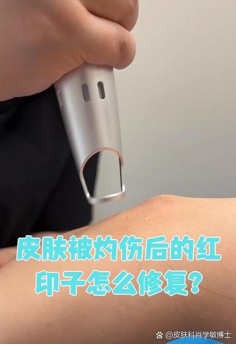 烫伤红印怎样去除