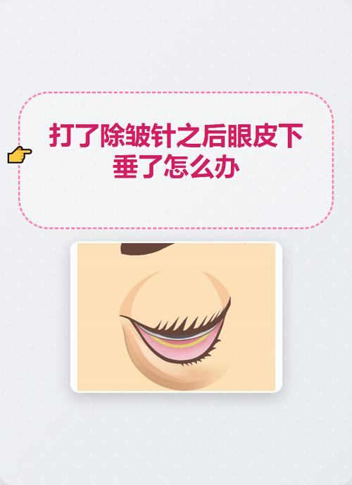 除皱针量用多了怎么补救