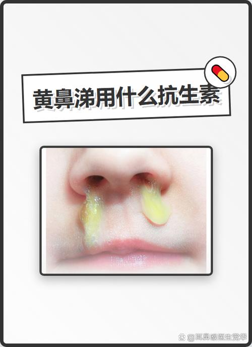 去除黄鼻涕小偏方