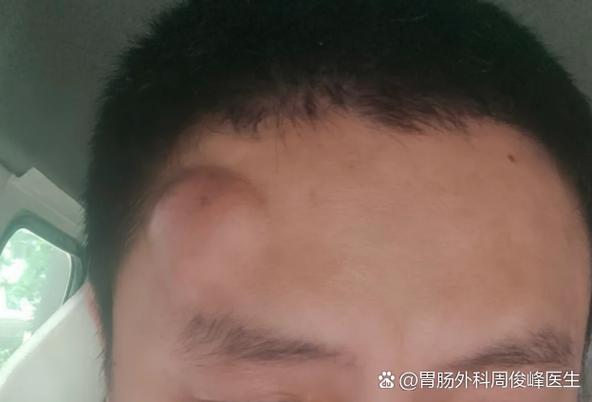 头上被锤子敲了又肿怎么办