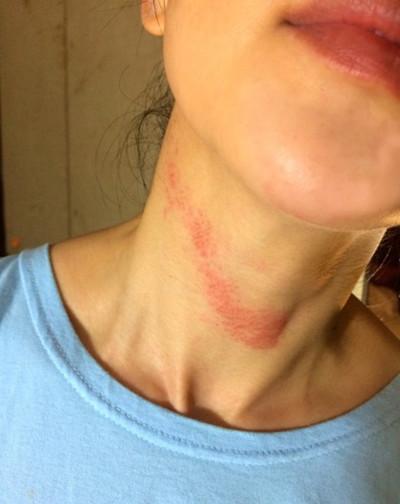 脖子上自己掐的红印几天能消