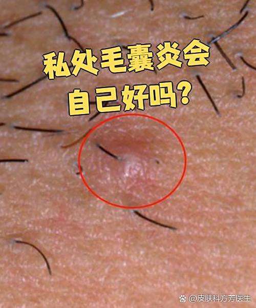 男生隐私毛囊炎图片