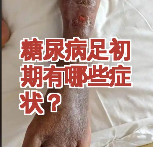 糖尿病一开始是什么症状