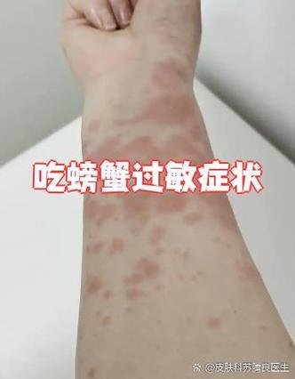 吃螃蟹过敏自己会好吗