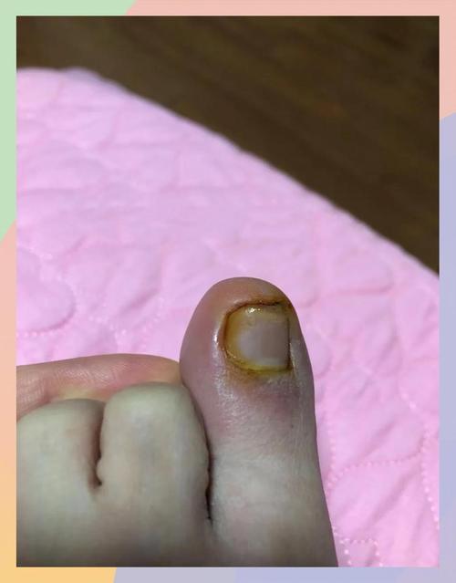 修脚店挖甲沟炎很疼吗
