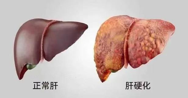 肝介入后一般寿命多长