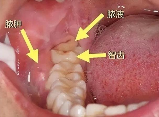 智齿