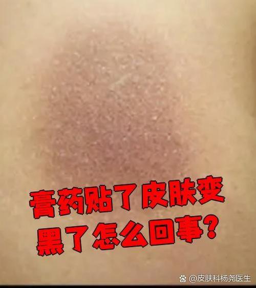 黑膏药粘在皮肤上