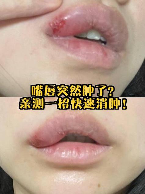 嘴巴被手机砸到肿了怎么处理