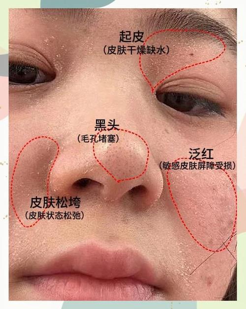 脸上大面积起皮是什么原因