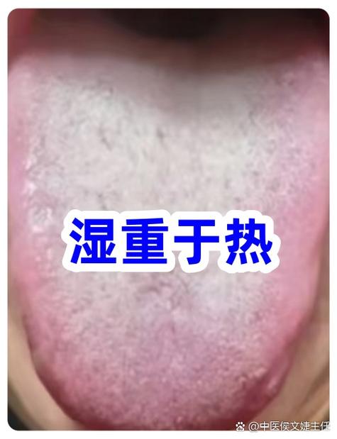湿气重的症状