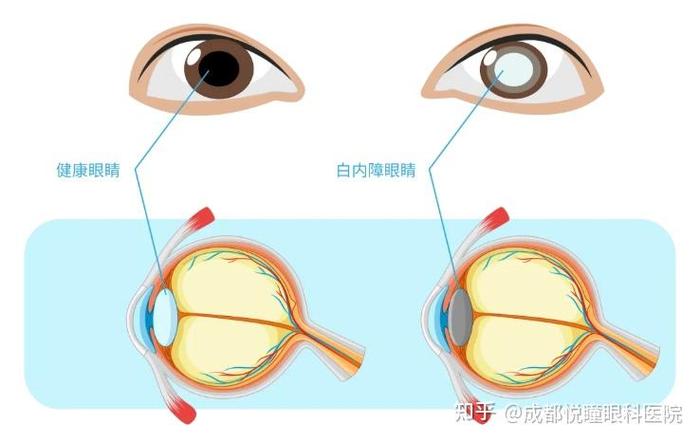 眼睛有白内障怎么治疗