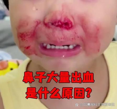 外伤导致流鼻血