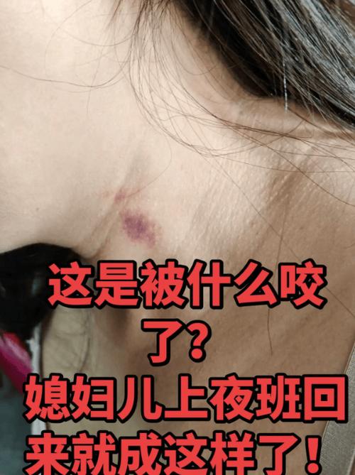 掐出来的红印是什么