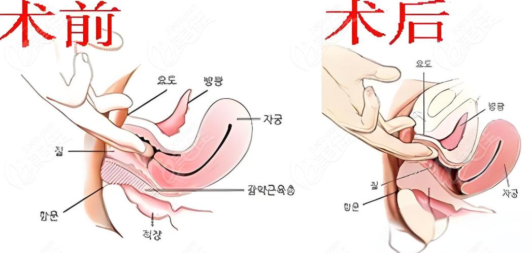 做私密紧缩术有副作用吗图标