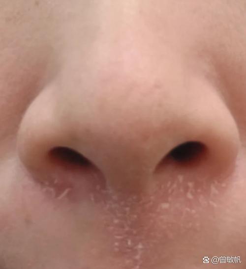 鼻梁上长癣怎么治疗
