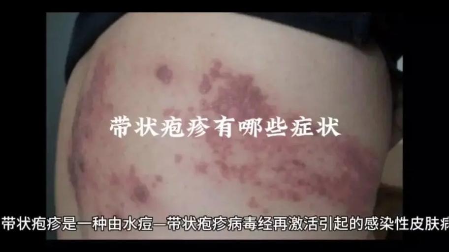 蛇盘疮是怎么引起的