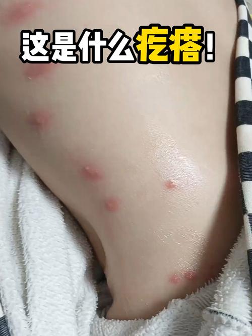 腋下有疙瘩痒越挠越痒
